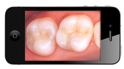 Vividia T12 Wireless Cordless USB/HDMI Dental Camera for TV monitor Android and PC/Mac