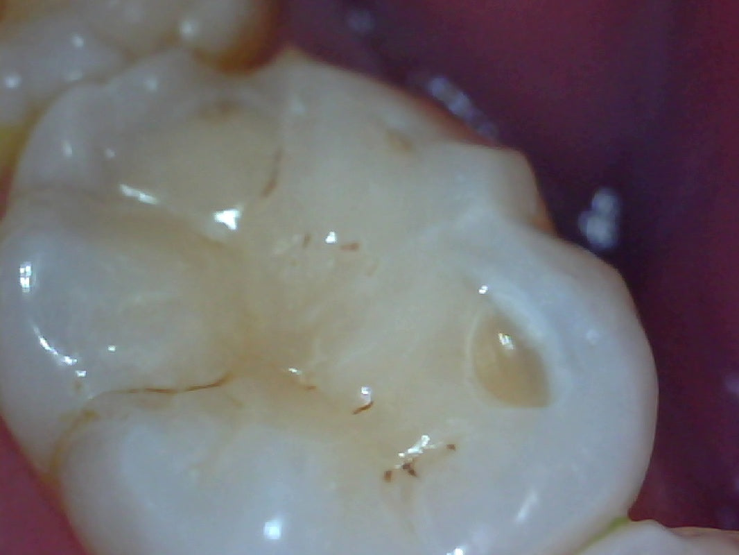 Vividia T12 Wireless Cordless USB/HDMI Dental Camera for TV monitor Android and PC/Mac