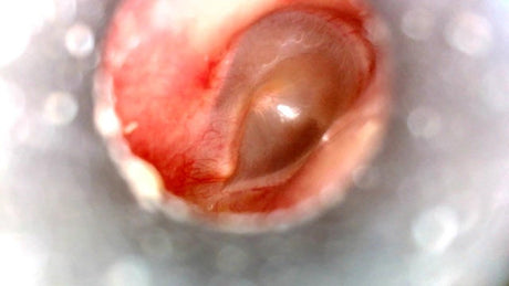 Digital Otoscopes