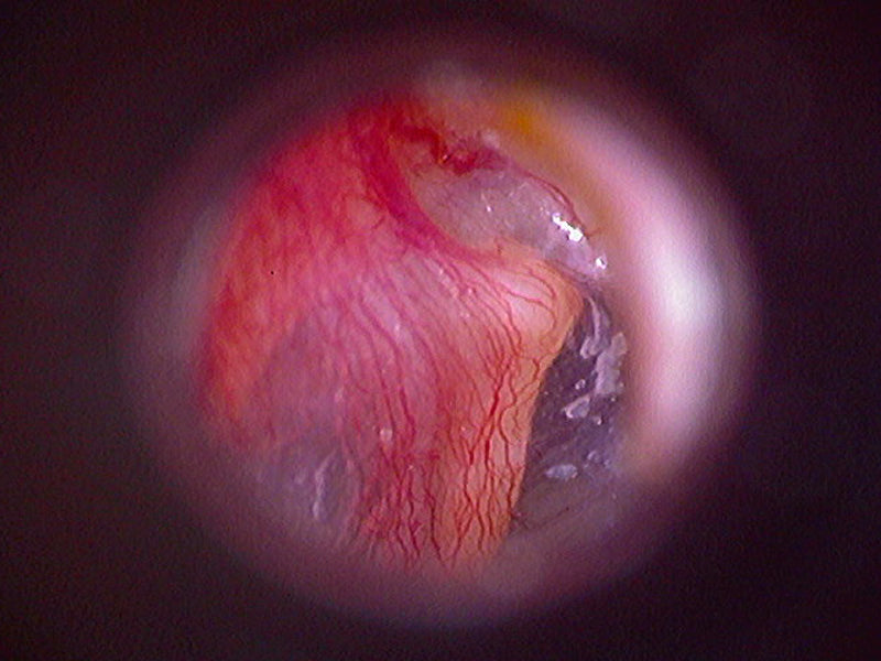 Firefly DE500 Handheld USB Digital Video Otoscope/ Earscope/ Auriscope